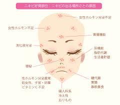 ☆ニキビができる場所によってわかること☆